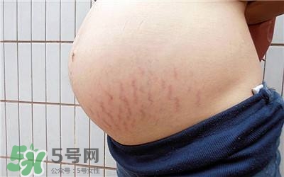 妊娠紋幾個月開始出現？妊娠紋能消除掉嗎？