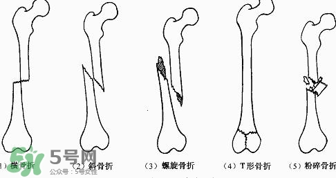 骨折吃什么好得快？骨折后注意事項