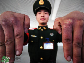 三月份還長凍瘡嗎？三月份凍瘡沒好怎么辦？