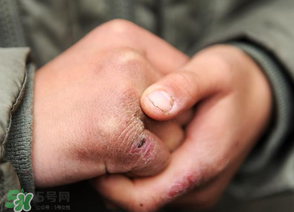 三月份還長凍瘡嗎？三月份凍瘡沒好怎么辦？