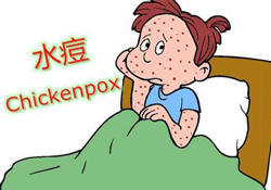 水痘是天花嗎？水痘是不是天花？