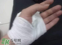 傷口化膿怎么處理？傷口化膿用什么藥好？