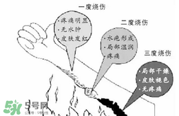 燙傷起泡要挑破嗎？燙傷起泡怎么處理？