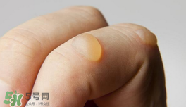 燙傷起泡要挑破嗎？燙傷起泡怎么處理？