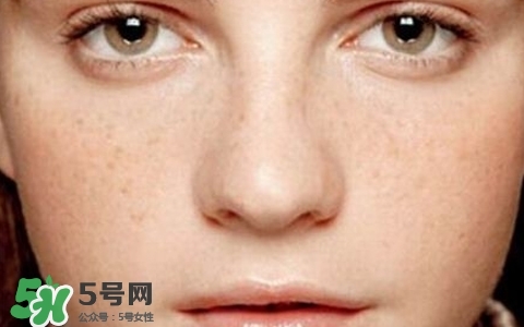 長斑是什么原因引起的？祛斑效果最好的方法