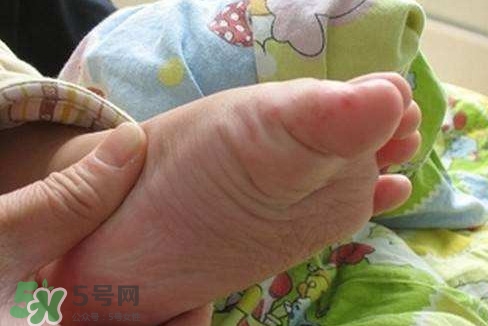 手足口病如何預(yù)防？手足口病怎樣預(yù)防