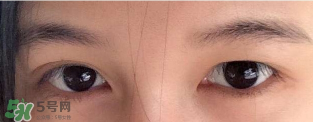 眼睛發(fā)黃是怎么回事？眼睛發(fā)黃是什么原因