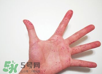 切辣椒后手很辣怎么辦？切辣椒后手很辣多久能好