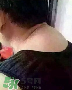 刮痧之后可以艾灸嗎？刮痧之后可不可以艾灸