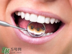補(bǔ)牙洞需要幾次完成?補(bǔ)牙洞需要多長時(shí)間?