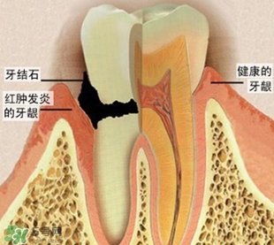 牙結石是什么？牙結石圖片