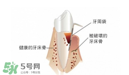 牙周炎怎么治療？牙周炎怎么治好