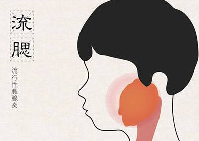流行性腮腺炎有哪些癥狀？流行性腮腺炎的癥狀