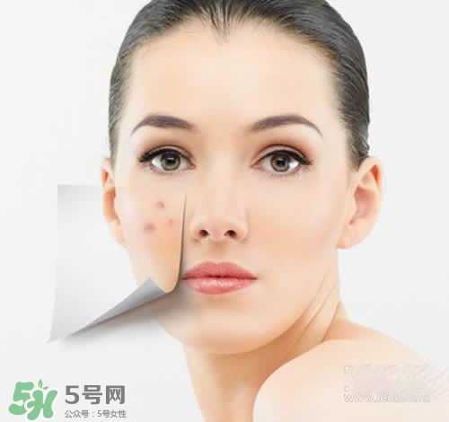 黑色痘印多久會消失？黑色痘印消失時間