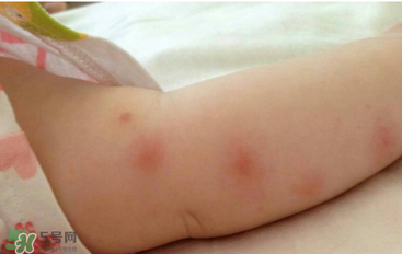 嬰兒蚊子咬了怎么消腫？嬰兒蚊子咬了怎么消腫止癢最快？