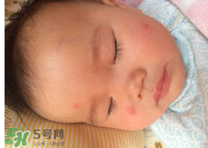 嬰兒蚊子咬了怎么消腫？嬰兒蚊子咬了怎么消腫止癢最快？