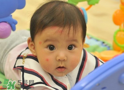 嬰兒被蚊子咬了如何去紅點(diǎn)？被蚊子咬后紅點(diǎn)如何去除？