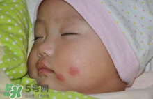 嬰兒被蚊子咬了如何去紅點(diǎn)？被蚊子咬后紅點(diǎn)如何去除？