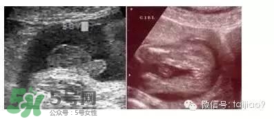B超單數(shù)據(jù)怎么看男女？B超單看男女準嗎？