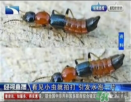 隱翅蟲有毒嗎？隱翅蟲會(huì)毀容嗎？