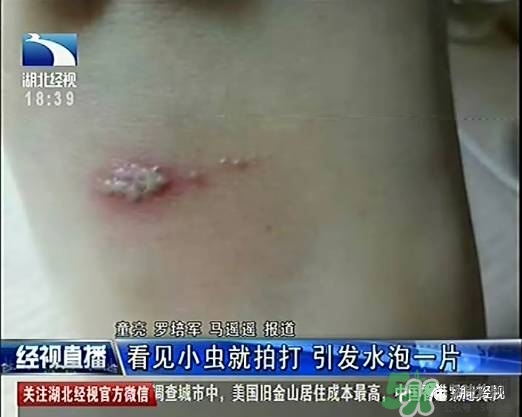 隱翅蟲有毒嗎？隱翅蟲會(huì)毀容嗎？