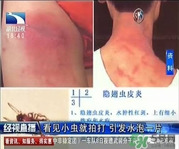 隱翅蟲有毒嗎？隱翅蟲會(huì)毀容嗎？