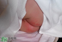 尿布疹怎么辦？寶寶尿布疹擦什么藥好？