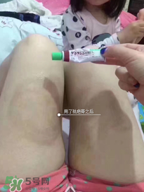 日本msd祛疤膏怎么樣？日本msd祛疤膏有用嗎？