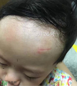 日本msd祛疤膏是抗生素嗎？日本msd祛疤膏是不是抗生素？