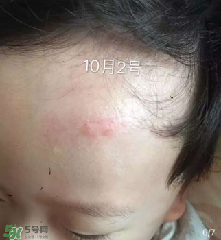 日本msd祛疤膏是抗生素嗎？日本msd祛疤膏是不是抗生素？