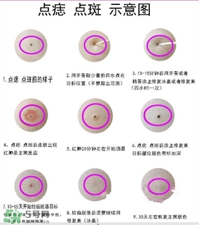 藥水點(diǎn)痣和激光點(diǎn)痣哪個(gè)好？各有什么優(yōu)缺點(diǎn)