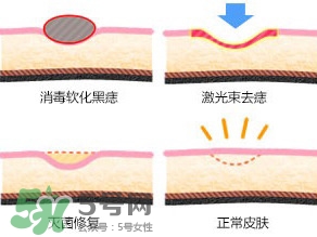 藥水點(diǎn)痣和激光點(diǎn)痣哪個(gè)好？各有什么優(yōu)缺點(diǎn)
