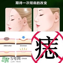 藥水點(diǎn)痣和激光點(diǎn)痣哪個(gè)好？各有什么優(yōu)缺點(diǎn)