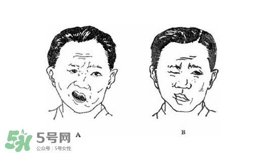 面癱是什么導致的？面癱多久徹底恢復正常