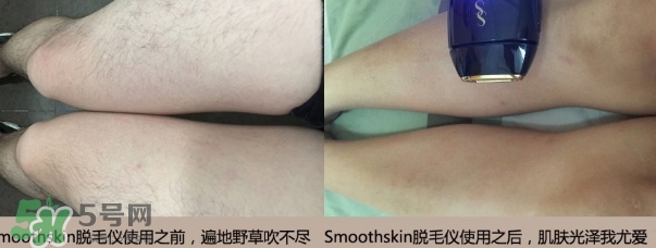 smoothskin和slikn infinity哪個(gè)好？smoothskin脫毛儀怎么樣