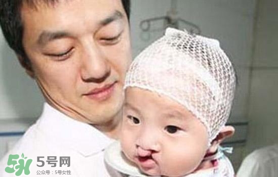兔唇是什么？兔唇是什么原因造成的？