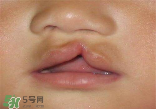 兔唇能檢查出來(lái)嗎？兔唇能完全修復(fù)嗎？