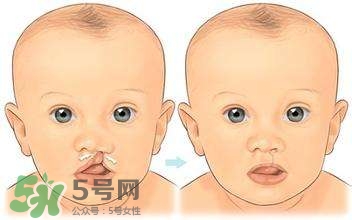 兔唇能檢查出來(lái)嗎？兔唇能完全修復(fù)嗎？