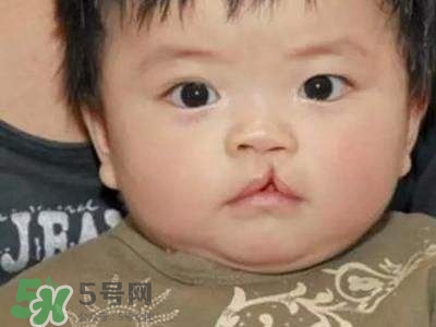 兔唇可以治嗎？兔唇修補術(shù)