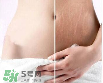 妊娠紋怎么長在大腿上了？妊娠紋會不會長在大腿上？