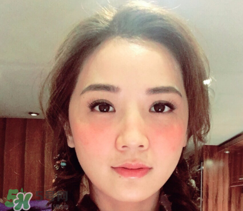 夏天可以點(diǎn)痣嗎？夏天點(diǎn)痣后要注意什么？