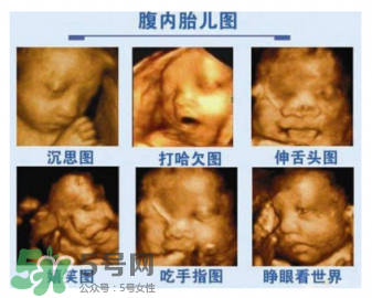 四維彩超有必要做嗎？四維彩超檢查不出什么？