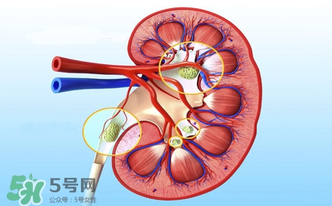 腎結(jié)石有什么癥狀？腎結(jié)石原因