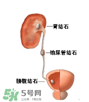 腎結(jié)石有什么癥狀？腎結(jié)石原因