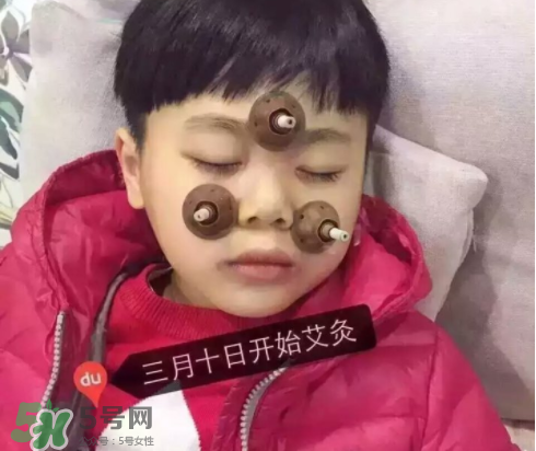 艾灸貼可以治咳嗽嗎？艾灸貼可以治退燒嗎？