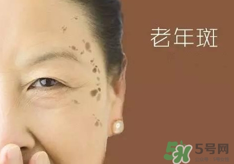 老年斑多大年齡開(kāi)始有？為什么牙膏能去老年斑？