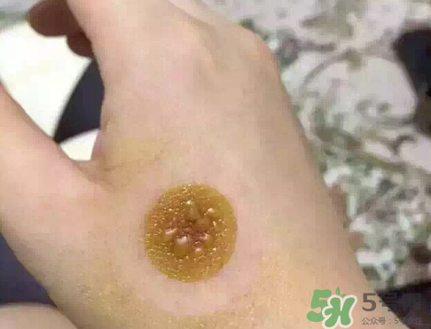艾灸貼后有水泡怎么辦？貼艾灸貼應注意些什么？