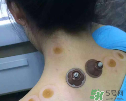 艾灸貼后有水泡怎么辦？貼艾灸貼應注意些什么？