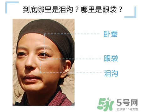 玻尿酸填充淚溝多久恢復自然？玻尿酸填充淚溝的危害