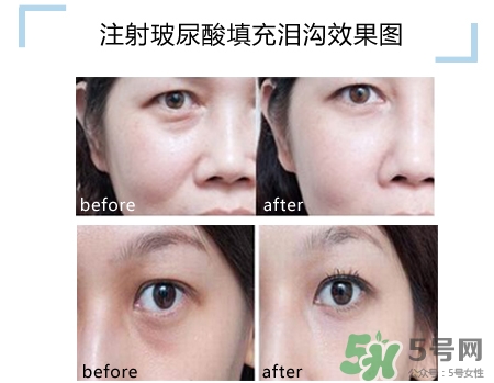玻尿酸填充淚溝多久恢復自然？玻尿酸填充淚溝的危害